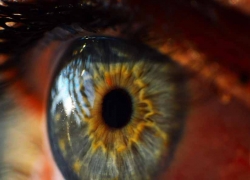 Eyelid Cancer: Diagnosis & risk factors